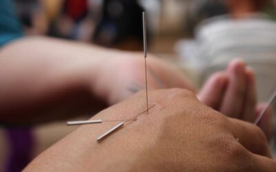 Wondering About Acupuncture?